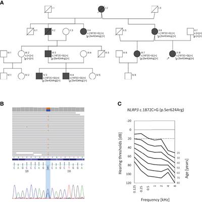 Hearing Loss as the Main Clinical Presentation in NLRP3-Associated Autoinflammatory Disease